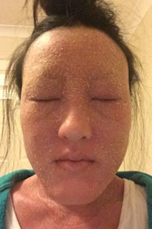 Further into withdrawal, Susan suffered severe flaking to the point her eyebrows fell out and never grew back.