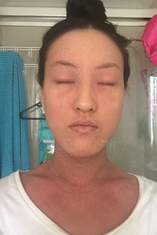 Susan To, 2 weeks into topical steroid withdrawal.