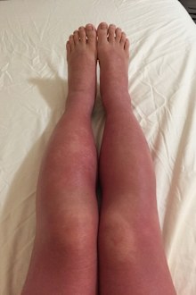 Susan suffered Oedema, with excess fluid trapped around her legs and ankles.