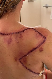 Teddi Mellencamp skin cancer battle
