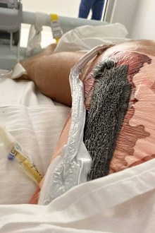 Michael Lindquist's leg, dressed with a vacuum seal, after his first surgery.