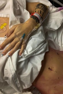 Niamh Anaya shows the incisions from endometriosis surgery.
