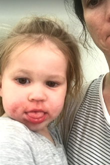 Poppy eczema