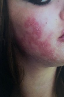 Liz suffers flare ups in the form of facial burns.