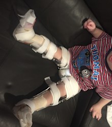 He was unable to use his legs until surgery when he was a toddler.