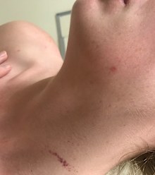 Tamara scratch on neck