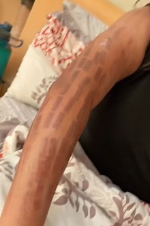 Laser hair removal bans