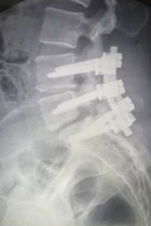 Trudy car accident recovery spinal fusion