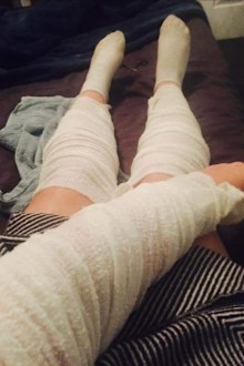 Jessica Peters eczema