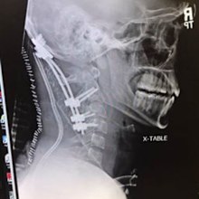 Surgeons carefully reconstructed his neck after the freak accident which usually kills.
