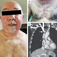 The man, aged 75, went to a dermatology clinic with erythema of the face, which doctors later found was linked to his pacemaker.