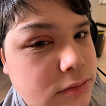 Gio shocking eye condition