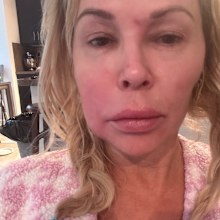 Brandi Glanville face disfigurement