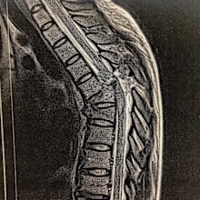 An X-ray shows the damage to Christina Vithoulkas's spine after the crash.