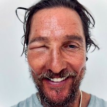 Matthew McConaughey after a bee sting