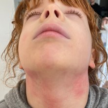 Amelia, six, lives with incredibly itchy skin.