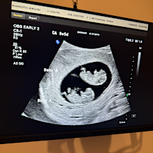 Nikolina Kharoufeh's twin pregnancy scan