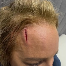 Carrie Bickmore smashed her head and has to undergo surgery after walking into a wall