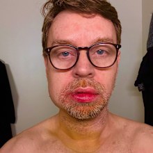Darren Hayes jaw injury
