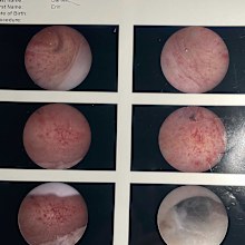 Every red spots and line in these photos show adenomyosis in the muscle of Erin Barnett's uterus. 