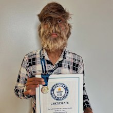 Lalit Patidar, 18, has the rare condition hypertrichosis, which has helped him set a Guinness World Record.