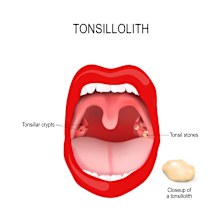 Tonsil stone