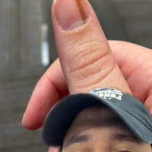 Streak on thumb cancer