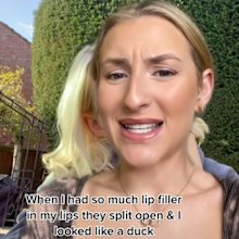 Woman's botched beauty filler
