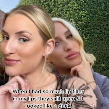 Woman's botched beauty filler