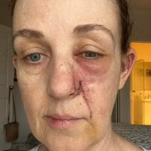 Tracy South Australia skin cancer