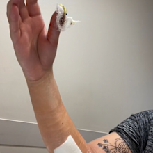 Skin graft cancer thumb