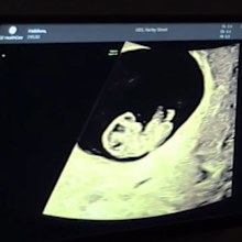 Sophie Habboo and Jamie Laing baby sonogram