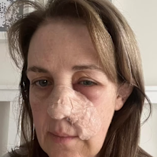 Tracy South Australia skin cancer