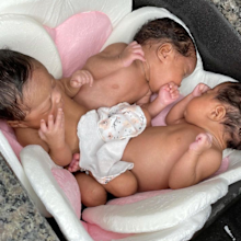 superfetation pregnancy