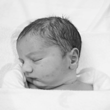 Miller Hypertonia and Global Developmental Delay disability