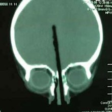 An X-ray showed the chopstick lodged 7cm in the brain of the toddler, who is expected to make a full recovery. (Supplied)