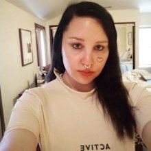 Amanda Bynes in process of getting face tattoo removed.