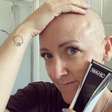 Katrina Hoult alopecia