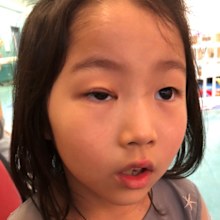 Cecilia's injured eye still looked noticeably different 10 months on from the accident, her mother said. 