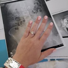 Woman swallows engagement ring in her sleep, needs surgery