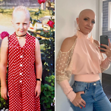 Katrina Hoult alopecia