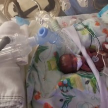 Girl believed to be tiniest newborn weighed as much as apple