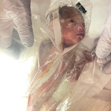 premature baby 