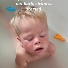 A photo taken of Tommy on day two of having chickenpox, before he went downhill. 