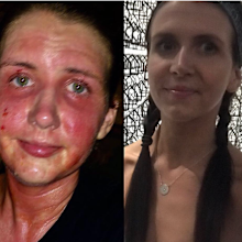 Claire eczema face