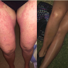 Claire eczema legs