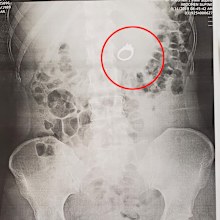Woman swallows engagement ring in her sleep, needs surgery