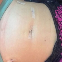 Kellie Johnson's stomach after surgery to manage her endometriosis.