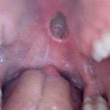 The ulcer on the roof of Saskia Rogers' mouth.