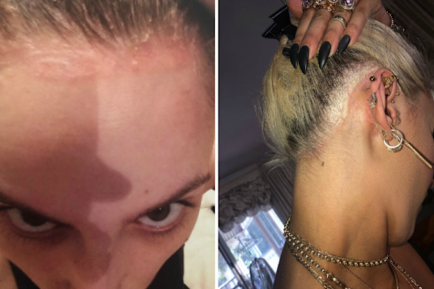 She began losing her hair in 2015 and wears hair extensions as a result.